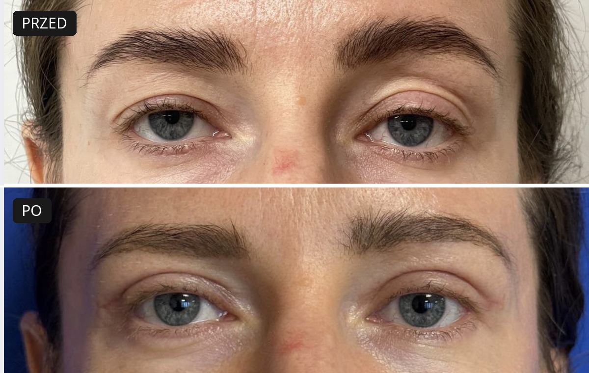 Efekt przed i po — Blefaroplastyka 4