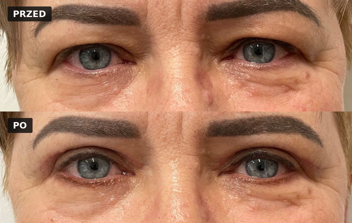 Efekt przed i po — Blefaroplastyka 5