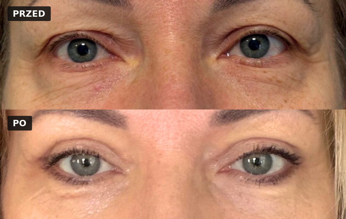 Efekt przed i po — Blefaroplastyka 3