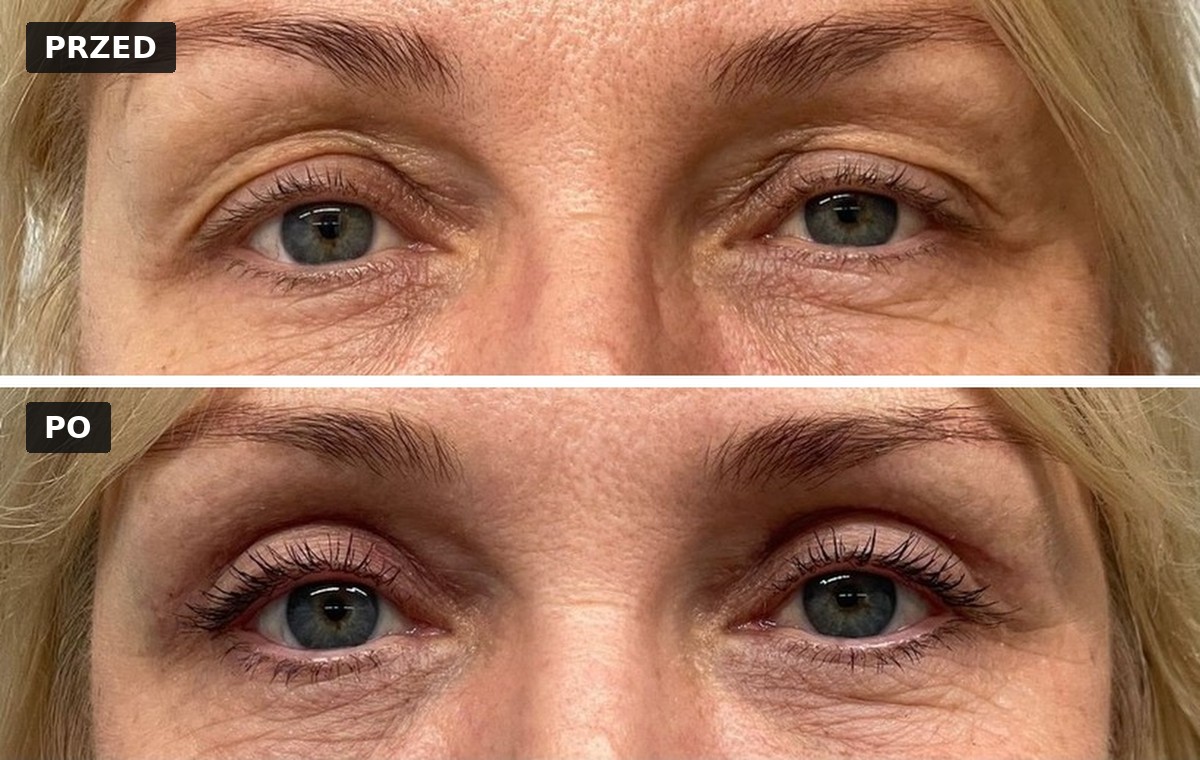 Efekt przed i po — Blefaroplastyka 1