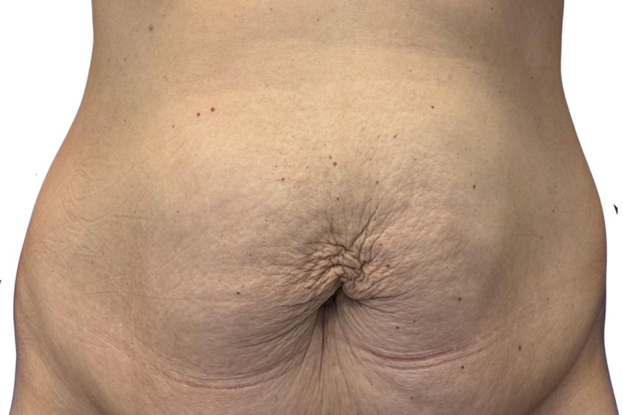 Przed — Plastyka brzucha 3