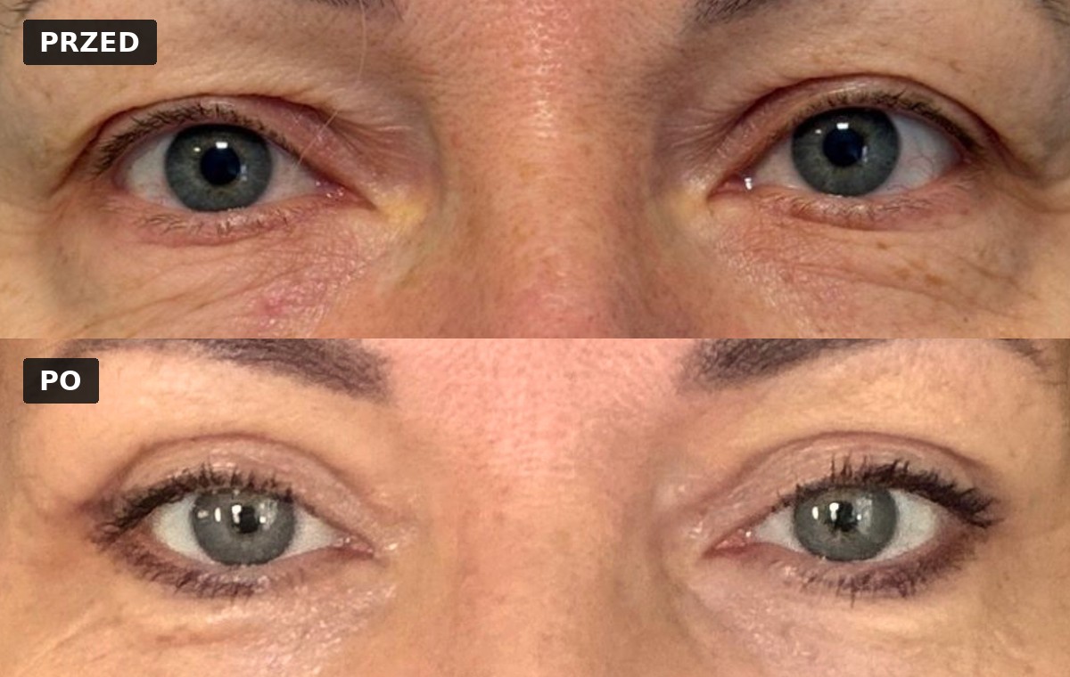 Efekt przed i po — Blefaroplastyka 2