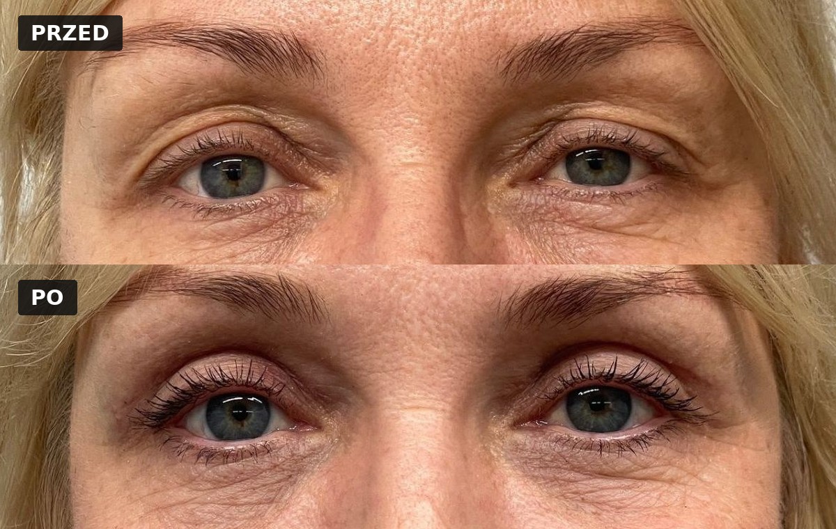 Efekt przed i po — Blefaroplastyka 6