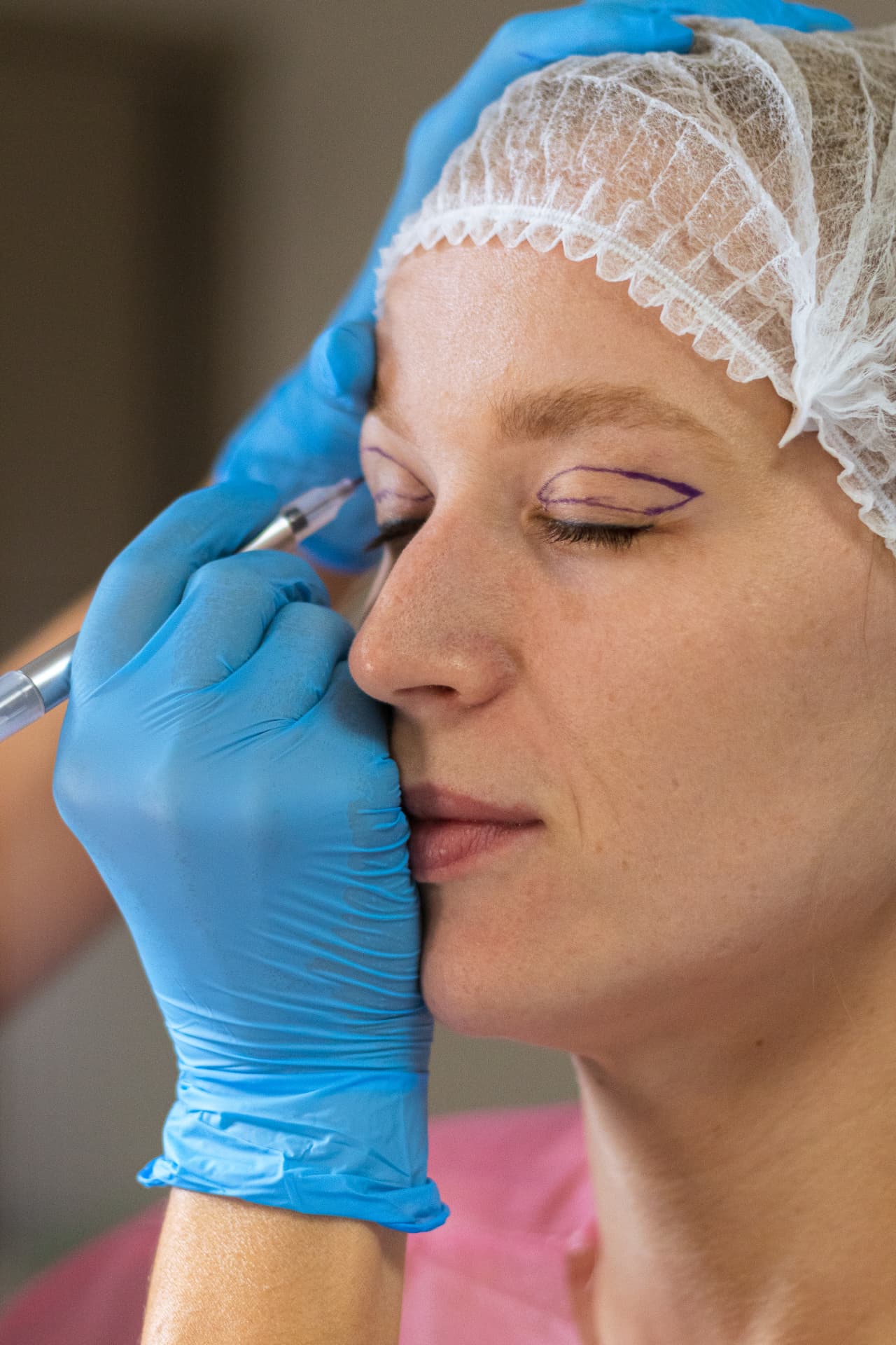 Blefaroplastyka