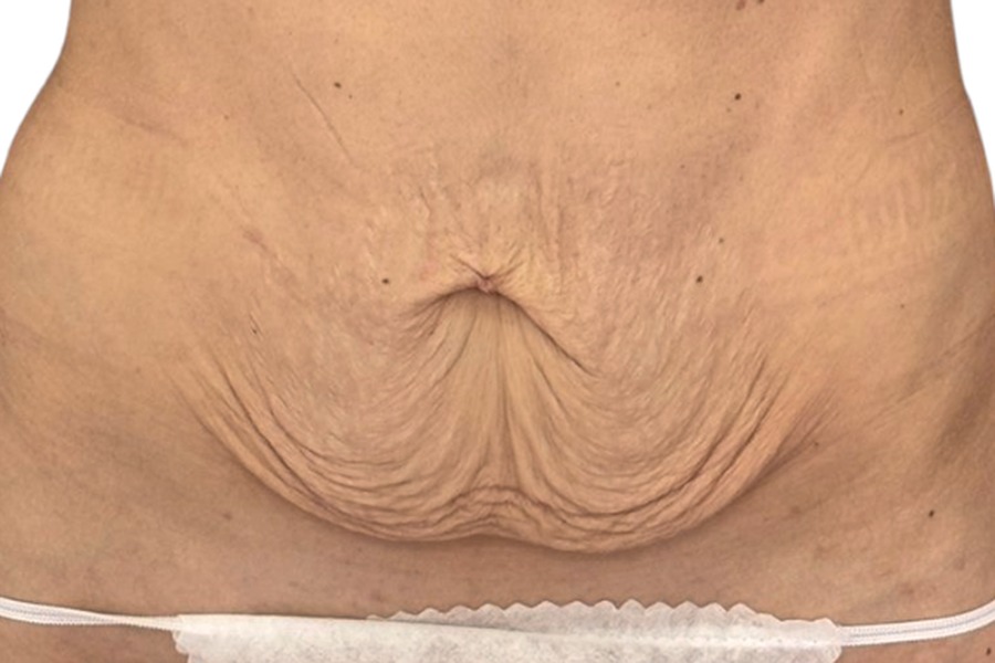 Przed — Plastyka brzucha 5