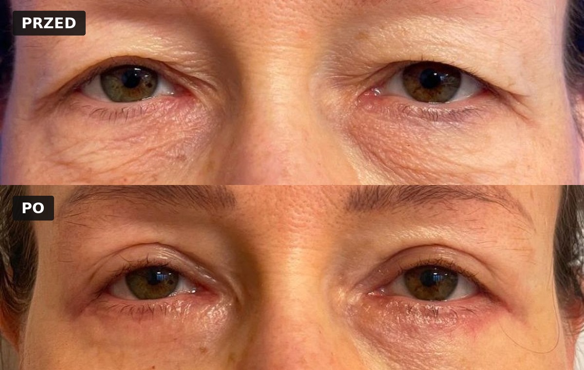 Efekt przed i po — Blefaroplastyka 7