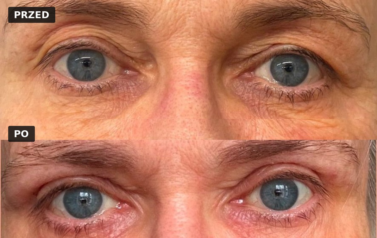 Efekt przed i po — Blefaroplastyka 8
